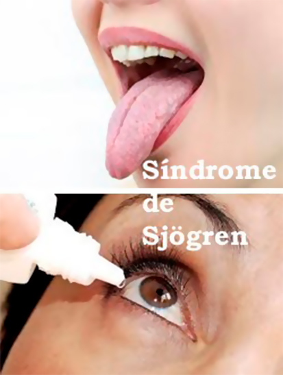 sjogren-1